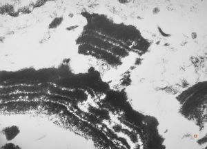 M,66y. | follicular cyst with hyaline Rushton bodies